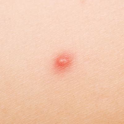 In rare cases, an unexplained lump, bump or swelling can be a sign of a more serious issue beneath the skin. . Lump in pubic area female under skin not painful reddit